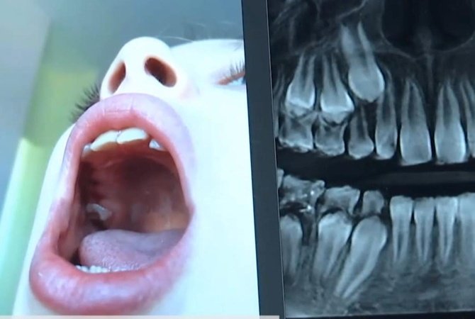 Под Киевом стоматологи по ошибке удалили девочке сразу 12 зубов
