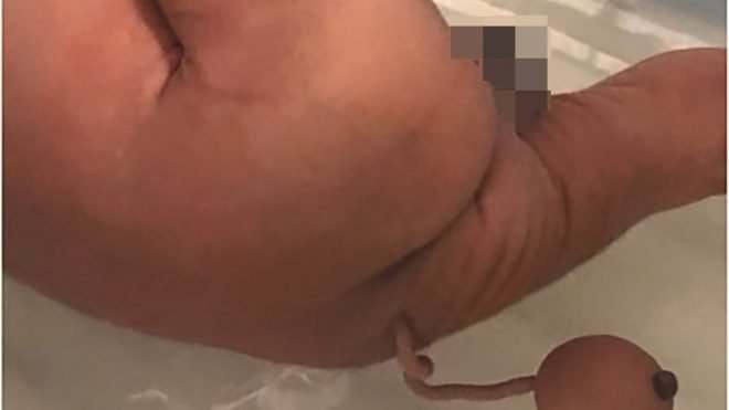В Бразилии новорожденному удалили хвост с шаром на конце
