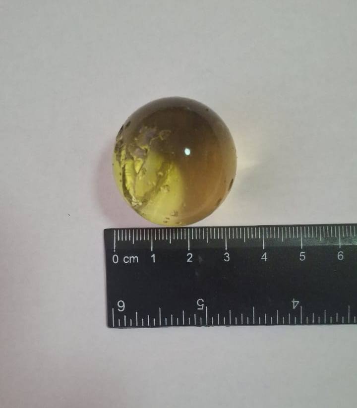 У Дніпрі лікарі врятували малюка, який проковтнув гідрогелеву кульку (ФОТО)