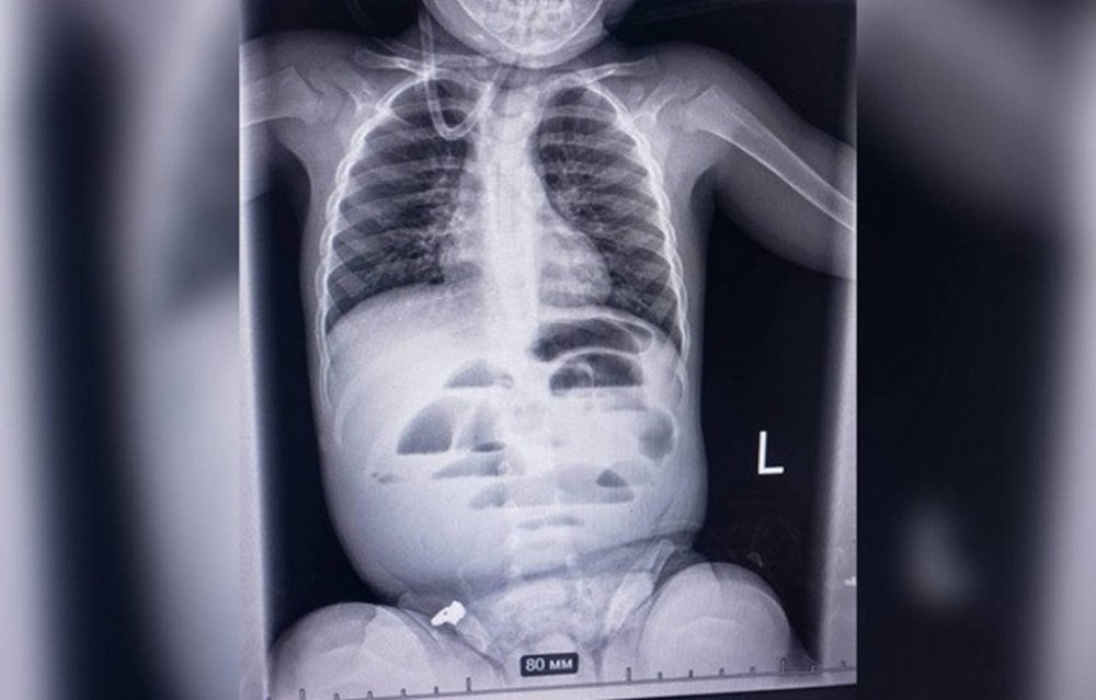 У Дніпрі лікарі врятували малюка, який проковтнув гідрогелеву кульку (ФОТО)