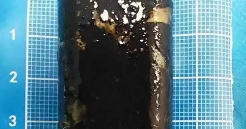 Вона все ще працювала: чоловік прожив 30 років із запальничкою у шлунку